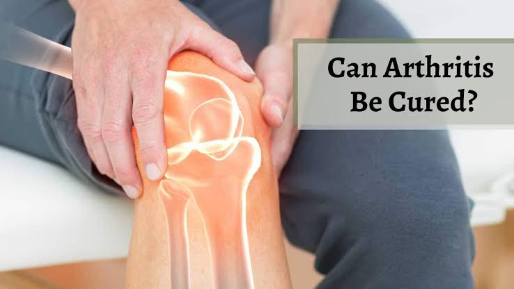Can Arthritis Be Cured Naturally? Effective Ways to Manage Symptoms